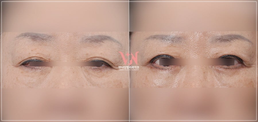 Midlife Eyelid Sagging Surgery: Which Cases Are Suitable for Upper Blepharoplasty or Brow Lift, Scars, Recovery Time — This Article Answers It All image 2
