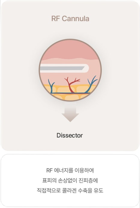 눈밑지방재배치 시술 효과, 통증, 붓기, 후 관리까지 이 글로 종결 관련 이미지 7