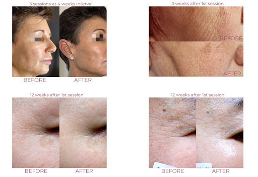 What the Reviews of Gouree Skin Booster Bought with My Own Money Say in Common image 20
