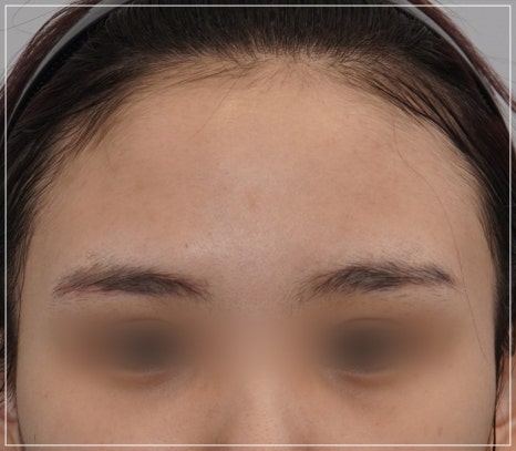 A Case Where Upper Blepharoplasty in Gangnam Won’t Help, a Plastic Surgeon’s Honest Opinion image 6