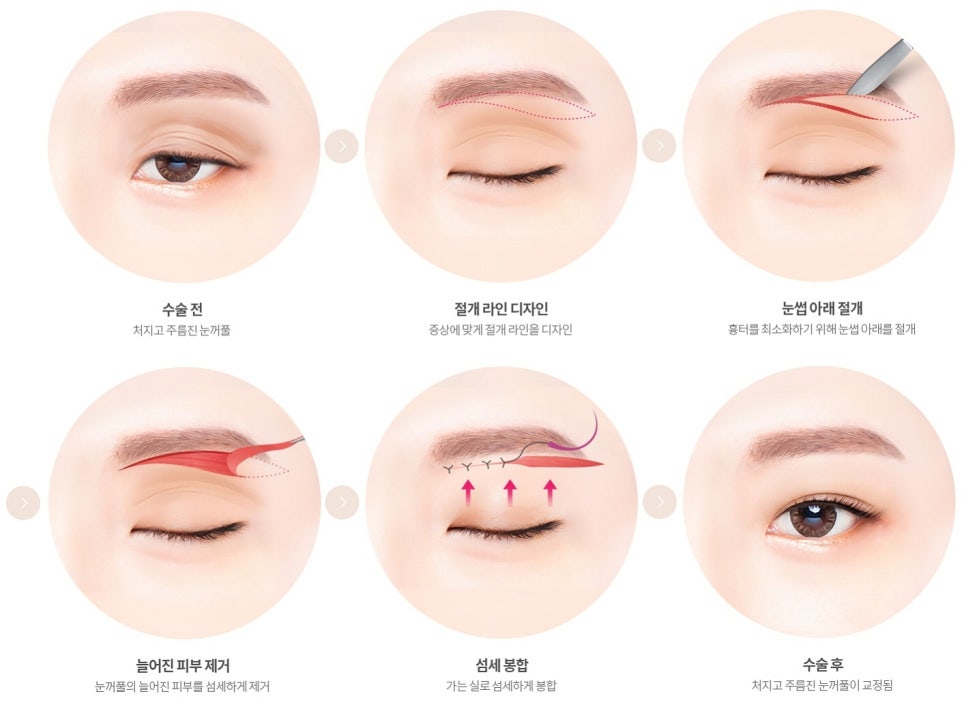 강남눈성형외과 잘하는 곳 구분하는 방법 3가지, 전문의가 알려드림 관련 이미지 4