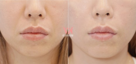 If your face is like this, "buccal fat removal" is not the first step — Gangnam "buccal fat lifting" is. image 32