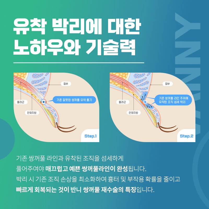 강남쌍꺼풀재수술 실패 원인을 파악한 뒤에 관련 이미지 6