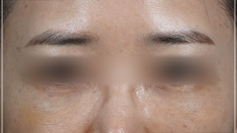 눈밑지방재배치 다크서클 해결 가능? 성형외과 전문의의 솔직 의견 관련 이미지 20