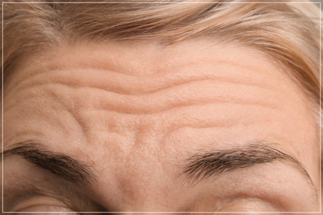 Midlife Eyelid Sagging Surgery: Which Cases Are Suitable for Upper Blepharoplasty or Brow Lift, Scars, Recovery Time — This Article Answers It All image 16