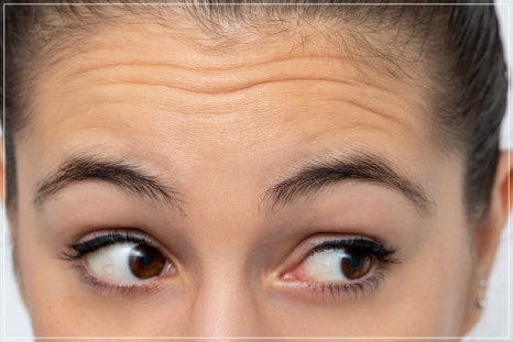 Midlife Eyelid Sagging Surgery: Which Cases Are Suitable for Upper Blepharoplasty or Brow Lift, Scars, Recovery Time — This Article Answers It All image 15
