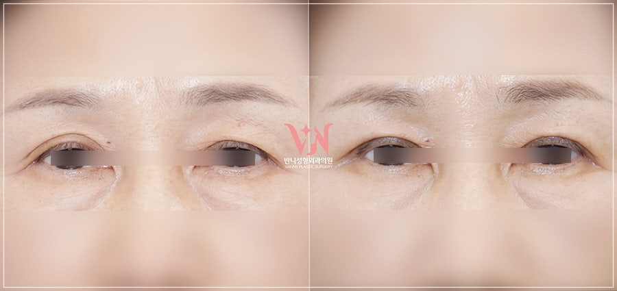 Midlife Eyelid Sagging Surgery: Which Cases Are Suitable for Upper Blepharoplasty or Brow Lift, Scars, Recovery Time — This Article Answers It All image 4