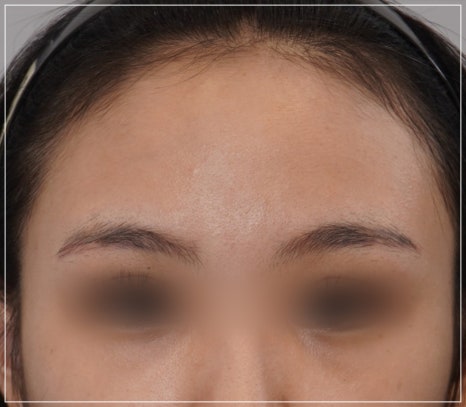A Case Where Upper Blepharoplasty in Gangnam Won’t Help, a Plastic Surgeon’s Honest Opinion image 7