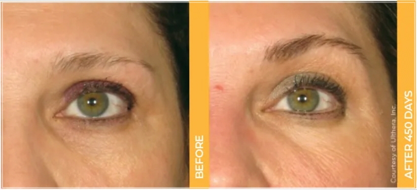 Eye Thermage and Eye Ulthera: Treatment Areas and Effects, a Dermatology Director's Honest Opinion image 15