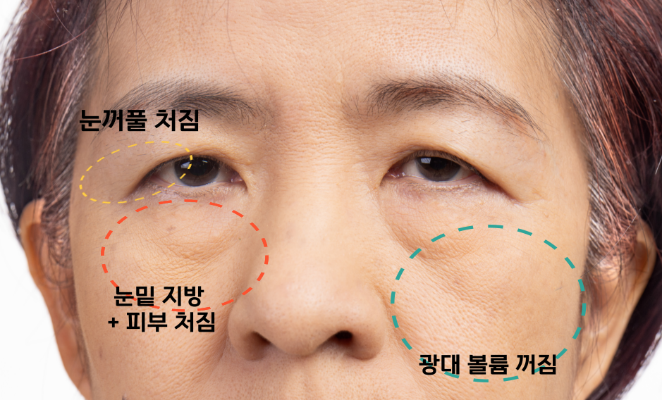 Honest Advice from a Plastic Surgeon on Finding a Good Clinic for Middle-Aged Eye Surgery image 3