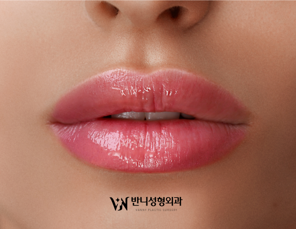 Natural Lip Filler: Achieving Volume and Harmony at the Same Time image 4