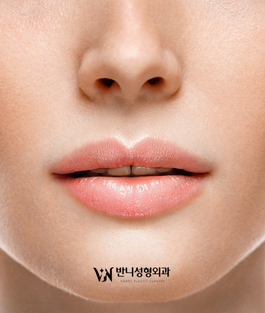 Lip Filler Before and After: A Choice for Natural, Attractive Lips image 5