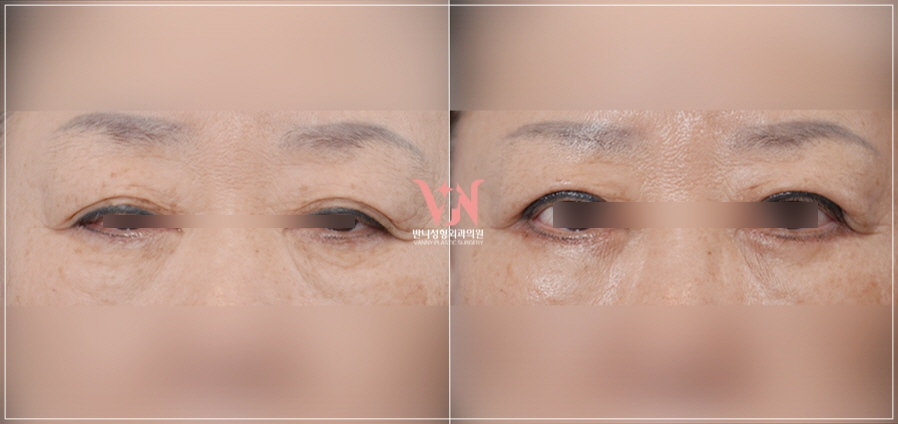 A Case Where Upper Blepharoplasty in Gangnam Won’t Help, a Plastic Surgeon’s Honest Opinion image 3