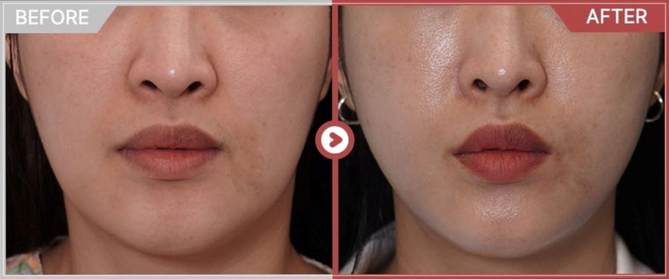 Do Not Go to a Clinic Where Thermage 300 Shots Cost Less Than 1 Million Won image 6
