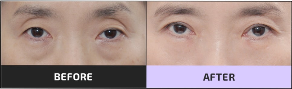 눈밑지방재배치 시술 효과, 통증, 붓기, 후 관리까지 이 글로 종결 관련 이미지 4