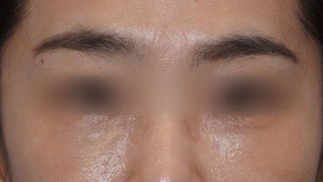 Eye Bag Repositioning Surgery Cost: A Plastic Surgeon Explains How to Find an Affordable, Good Clinic image 5