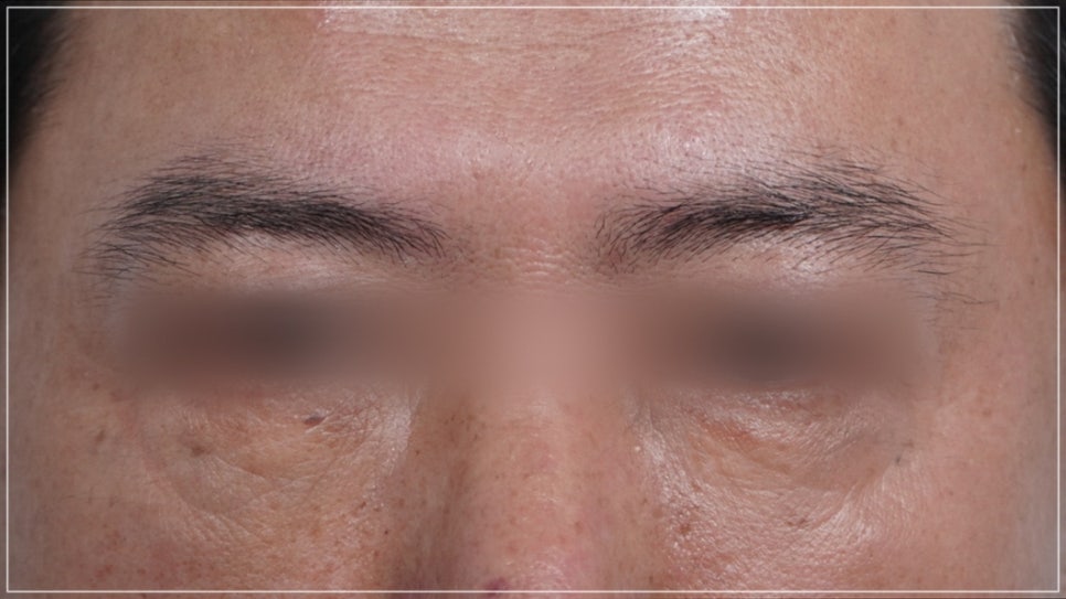 Conditions for Under-Eye Fat Repositioning in Gangnam That Lasts Long, Is Safe, and Allows a Quick Return to Daily Life image 5