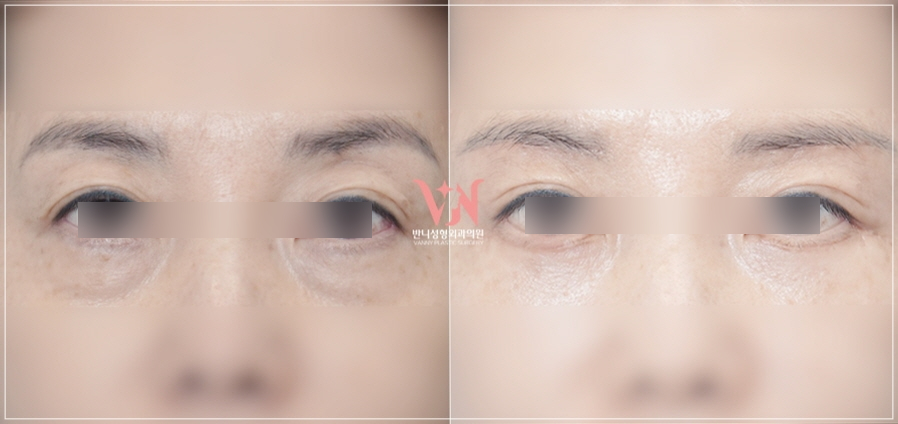 The One Critical Question to Avoid Revision Under-Eye Fat Repositioning (+Causes of Recurrence) image 4