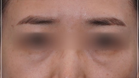 눈밑지방재배치 다크서클 해결 가능? 성형외과 전문의의 솔직 의견 관련 이미지 19