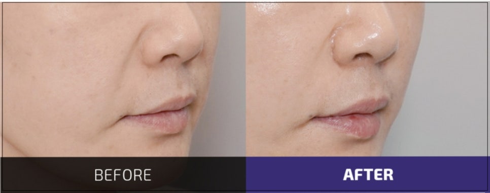 The Best Place for Thread Lifting for Nasolabial Folds in Gangnam Improves Both Hollowness and Sagging. image 6