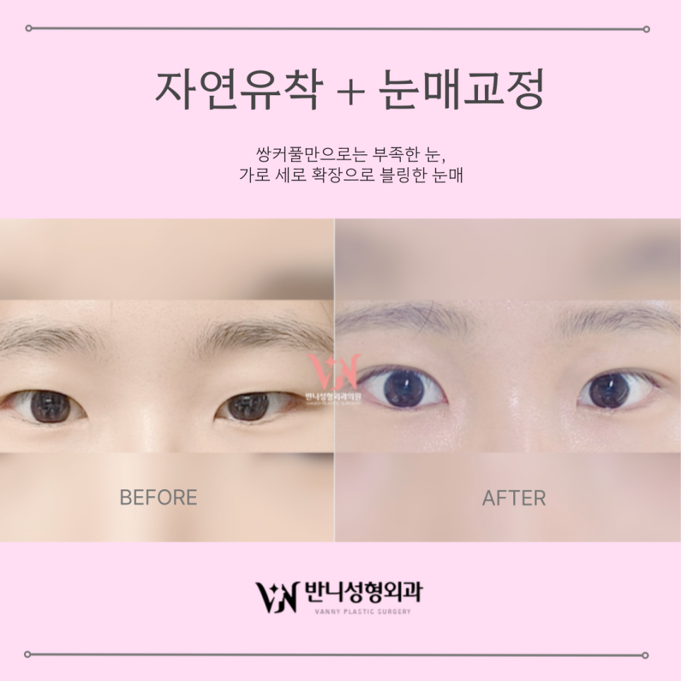 Before and After Ptosis Correction: How to Create a Clear and Natural Change image 4