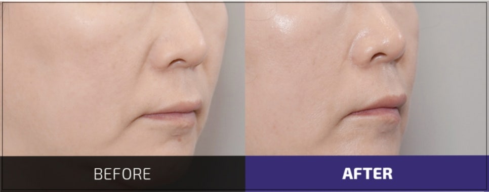 The Best Place for Thread Lifting for Nasolabial Folds in Gangnam Improves Both Hollowness and Sagging. image 5
