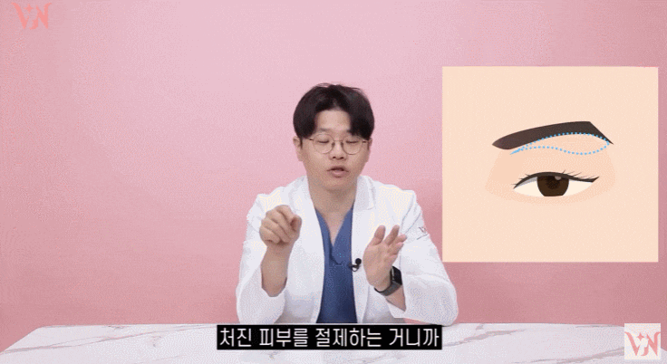 A Case Where Upper Blepharoplasty in Gangnam Won’t Help, a Plastic Surgeon’s Honest Opinion image 11