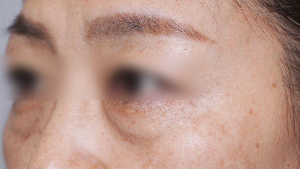 Eye Bag Repositioning Surgery Cost: A Plastic Surgeon Explains How to Find an Affordable, Good Clinic image 13