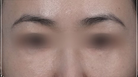 눈밑지방재배치 다크서클 해결 가능? 성형외과 전문의의 솔직 의견 관련 이미지 7