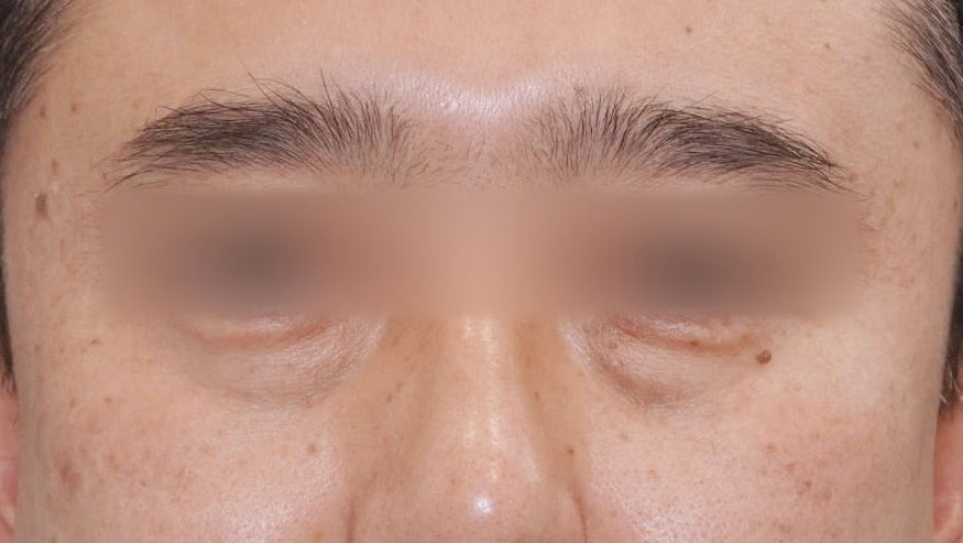 Eye Bag Repositioning Surgery Cost: A Plastic Surgeon Explains How to Find an Affordable, Good Clinic image 7