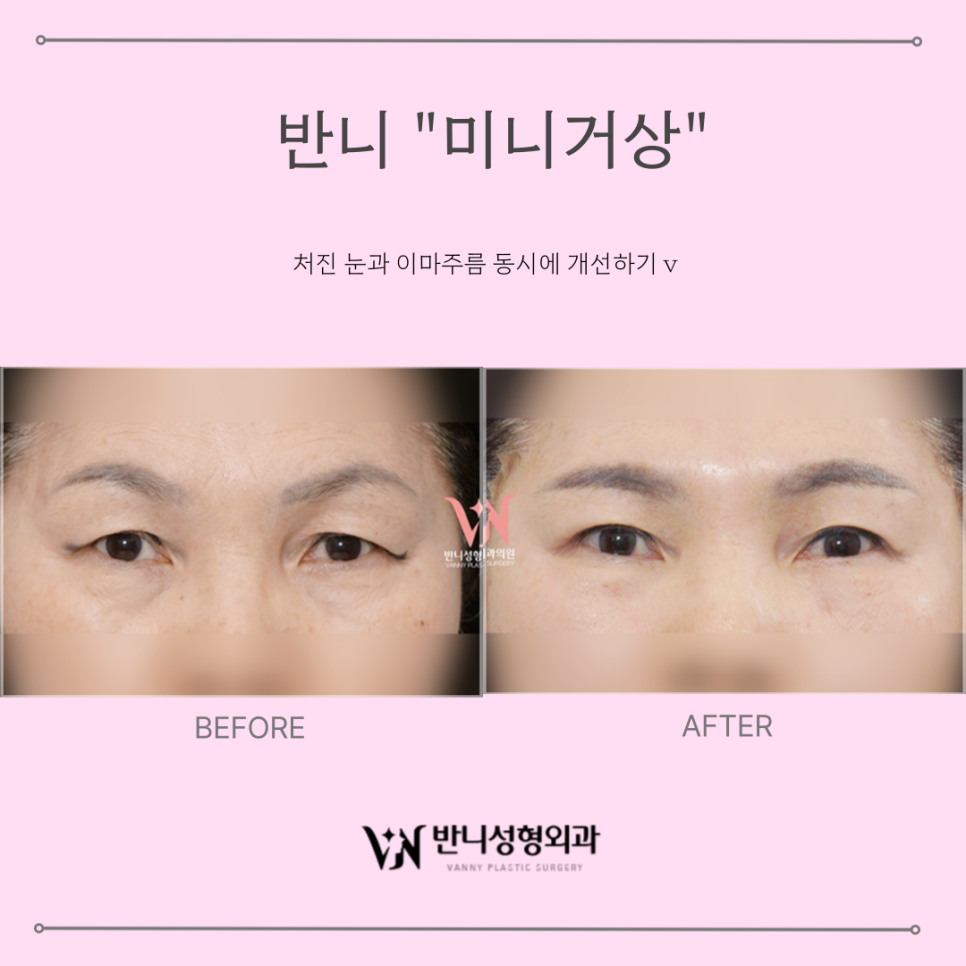 Forehead Lift Before and After: If You Want a Safer and More Effective Method image 2