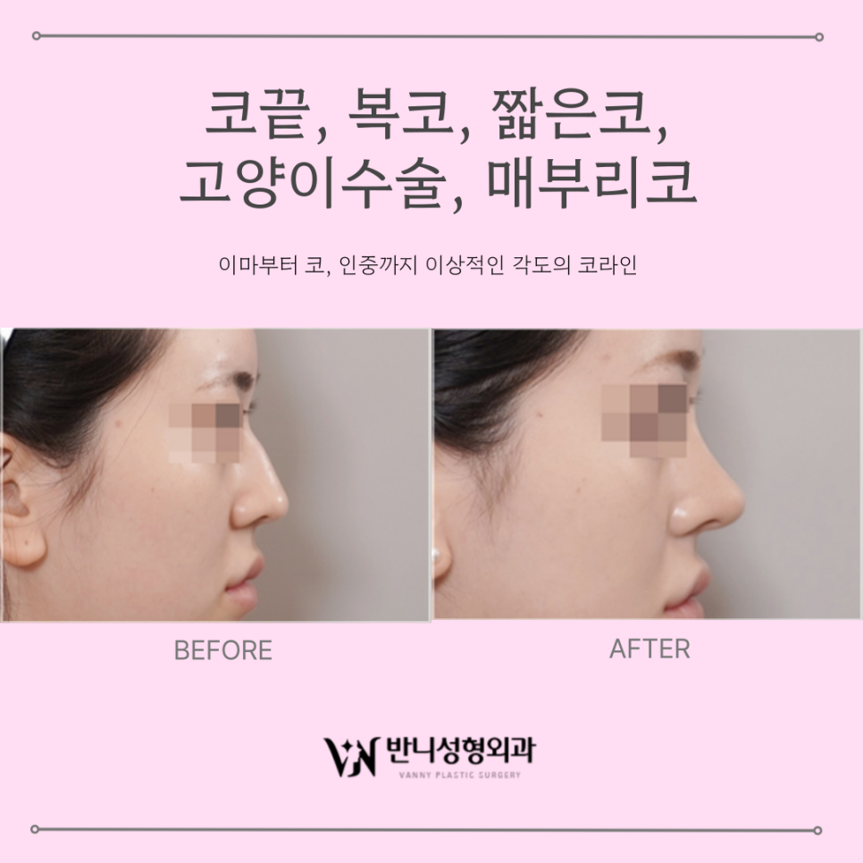 반니성형외과 시술사례 모음 zip 관련 이미지 2