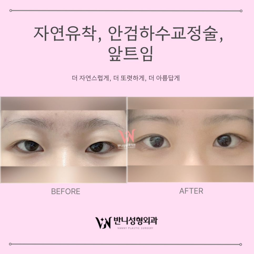 쌍커풀 자연유착 : 반짝유착으로 오래 유지되는 자연스러운 눈매 관련 이미지 8
