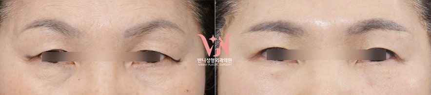 Honest Advice from a Plastic Surgeon on Finding a Good Clinic for Middle-Aged Eye Surgery image 5