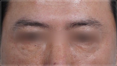 강남눈성형외과 잘하는 곳 구분하는 방법 3가지, 전문의가 알려드림 관련 이미지 11