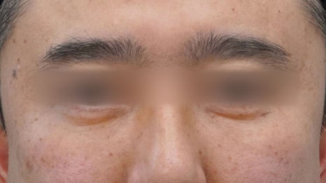 Eye Bag Repositioning Surgery Cost: A Plastic Surgeon Explains How to Find an Affordable, Good Clinic image 10