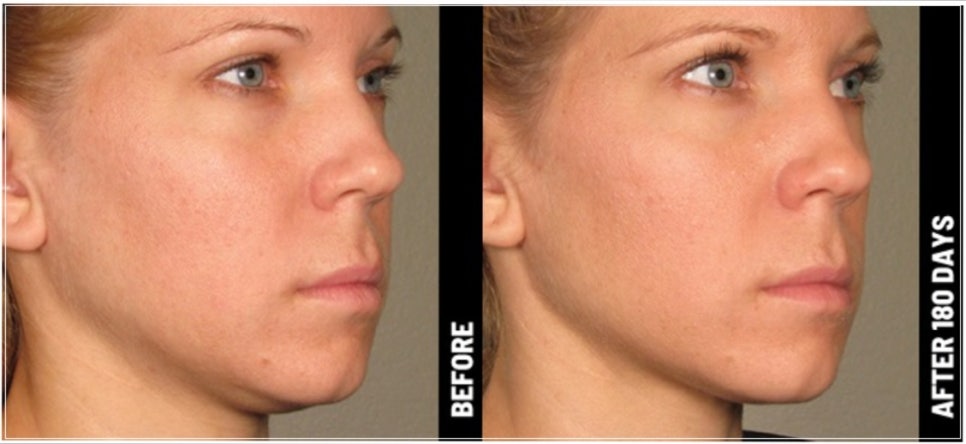Ultherapy Effectiveness: Fact Check for Thin Faces O, Filling Sunken Areas X (+ Gangnam Event Dermatology Clinic) image 10