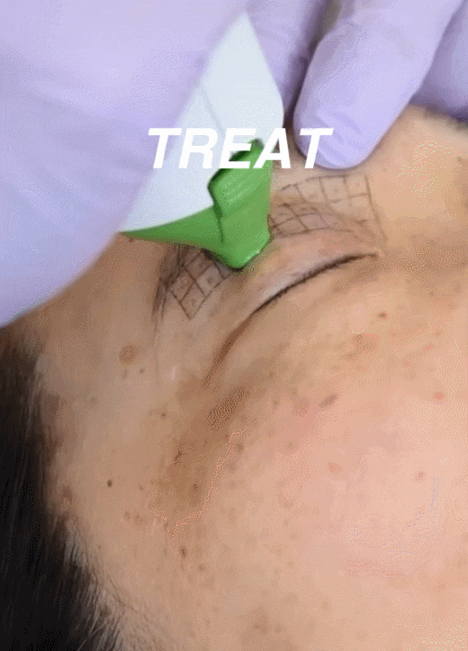 Eye Thermage and Eye Ulthera: Treatment Areas and Effects, a Dermatology Director's Honest Opinion image 13