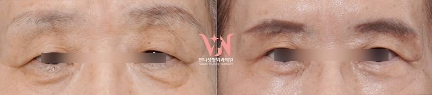 Honest Advice from a Plastic Surgeon on Finding a Good Clinic for Middle-Aged Eye Surgery image 9