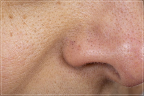 How to Reduce Pores in Gangnam: The Real Effect of Potenza Pumping Tip for Nose Pores, Explained by a Dermatology Clinic Director image 7