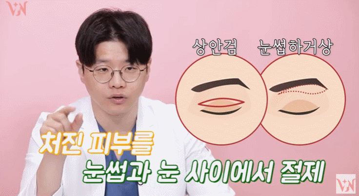 A Case Where Upper Blepharoplasty in Gangnam Won’t Help, a Plastic Surgeon’s Honest Opinion image 16