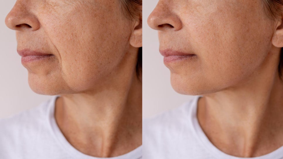 If your face is like this, "buccal fat removal" is not the first step — Gangnam "buccal fat lifting" is. image 14