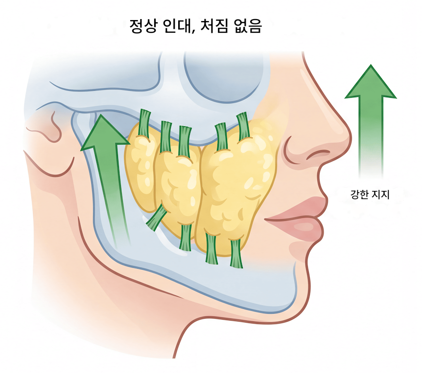 If your face is like this, "buccal fat removal" is not the first step — Gangnam "buccal fat lifting" is. image 5