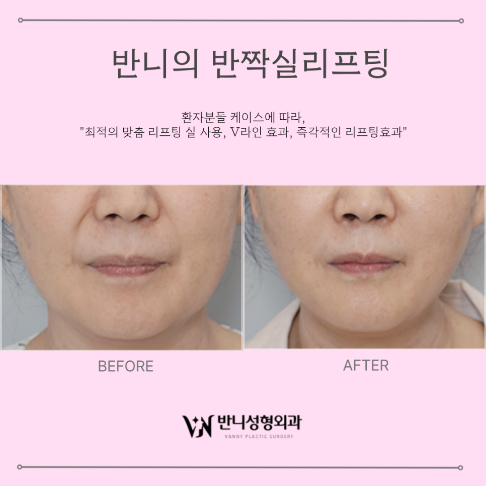강남 실리프팅 : 무조건 당기기만 하는 시술은 그만! 동안 얼굴을 원한다면 필독. 관련 이미지 2