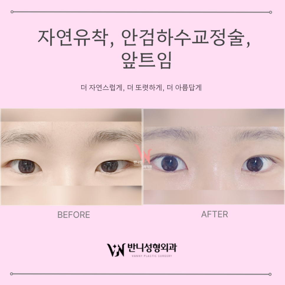 쌍커풀 자연유착 : 반짝유착으로 오래 유지되는 자연스러운 눈매 관련 이미지 7