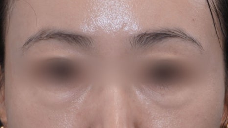 Under-Eye Fat Repositioning Recovery Period: Just Two Days! A Plastic Surgeon Reveals the Conditions for a Quick Return to Daily Life image 4