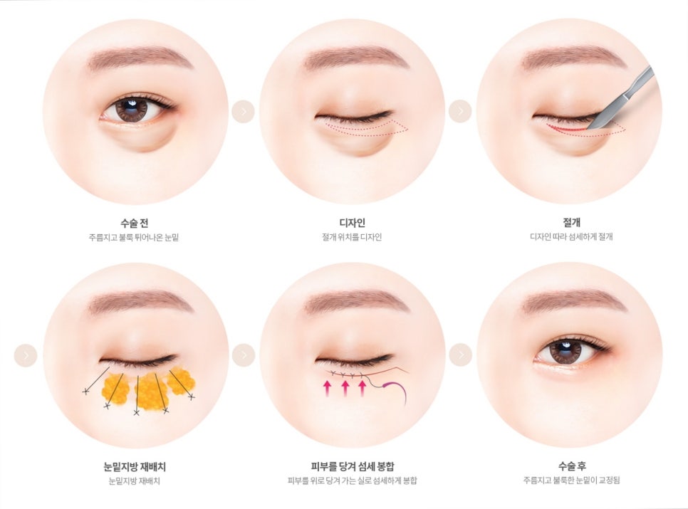강남 하안검수술 잘하는 병원 가릴 수 있는 3가지 질문(부작용) 관련 이미지 3