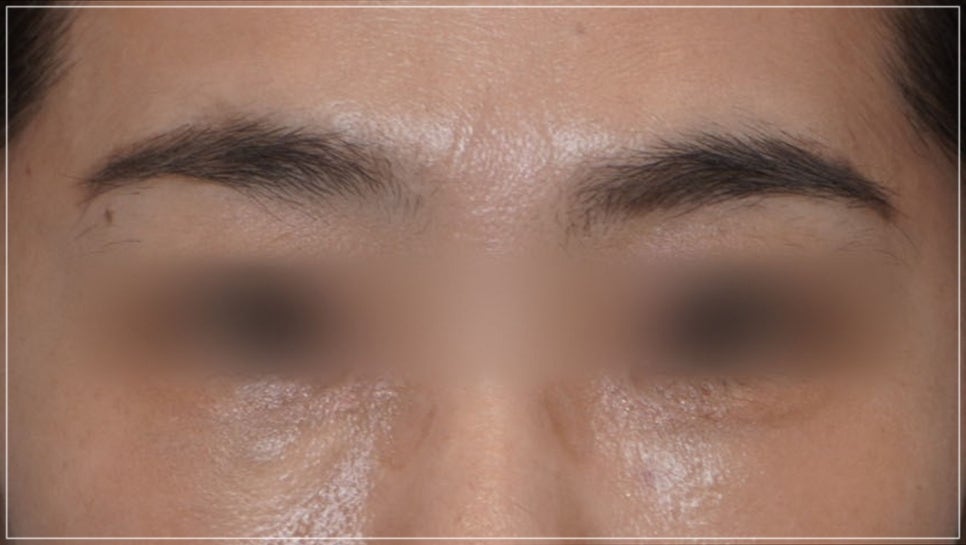 Conditions for Under-Eye Fat Repositioning in Gangnam That Lasts Long, Is Safe, and Allows a Quick Return to Daily Life image 10