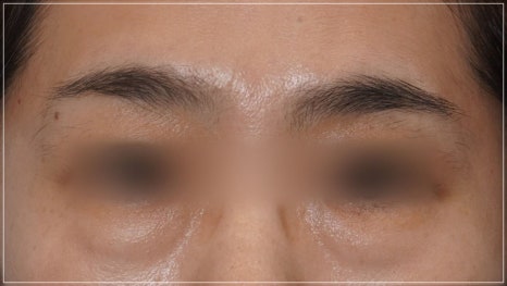 Conditions for Under-Eye Fat Repositioning in Gangnam That Lasts Long, Is Safe, and Allows a Quick Return to Daily Life image 11