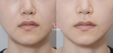 If your face is like this, "buccal fat removal" is not the first step — Gangnam "buccal fat lifting" is. image 31